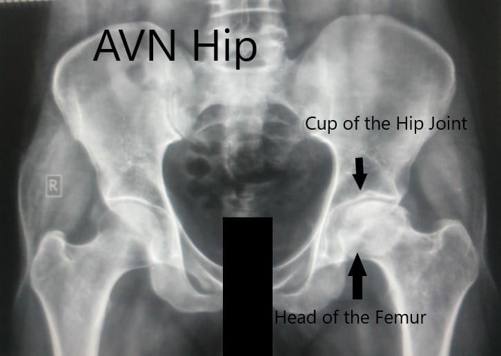 Anteroposterior view of the pelvis with both hips