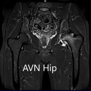 MRI images showing avascular necrosis of the left hip with collapse