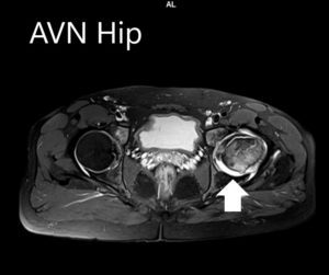 MRI images showing avascular necrosis of the left hip with collapse - scan 2