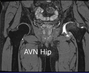 MRI images showing avascular necrosis of the left hip with collapse -scan 3