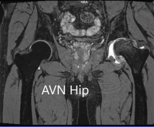 Imágenes de resonancia magnética que muestran necrosis avascular de la cadera izquierda con colapso -gammagrafía 3