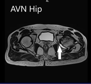 MRI images showing avascular necrosis of the left hip with collapse - scan 4