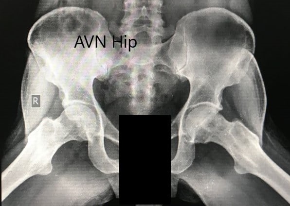 Preoperative X-ray of the pelvis with both hips in the frog-legged lateral view showing AVN of the bilateral hips