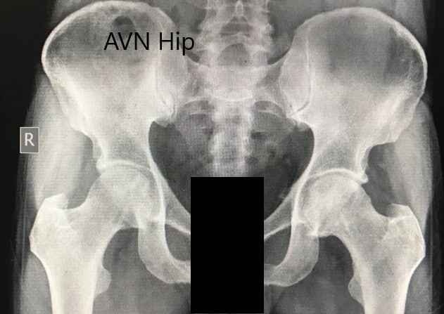 Preoperative X-ray of the pelvis with both hips in anteroposterior view showing AVN of the bilateral hips