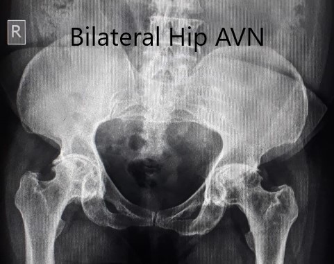 Preoperative X-ray of the pelvis in anteroposterior view