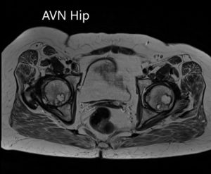 Axial sections of T1WI of the pelvis MRI