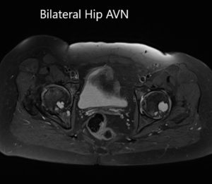 Axial sections of T2WI of the pelvis MRI