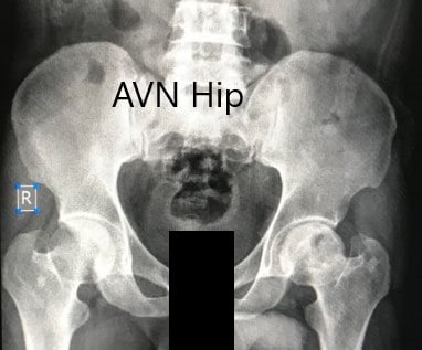 Preoperative X-ray of the pelvis with both hips in anteroposterior view showing AVN of the Left Hip