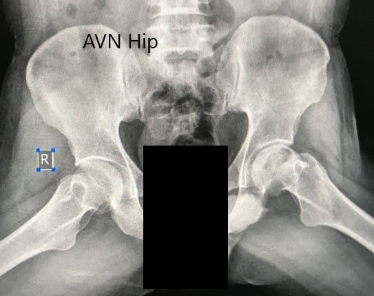 Preoperative X-ray of the pelvis with both hips in the frog-legged lateral view showing AVN of the Left Hip