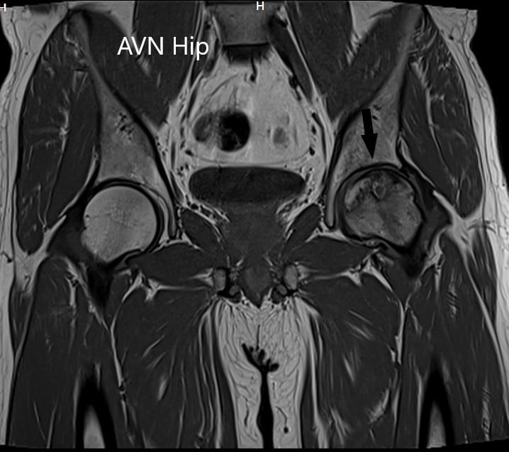 T1WI coronal section of MRI showing AVN hip
