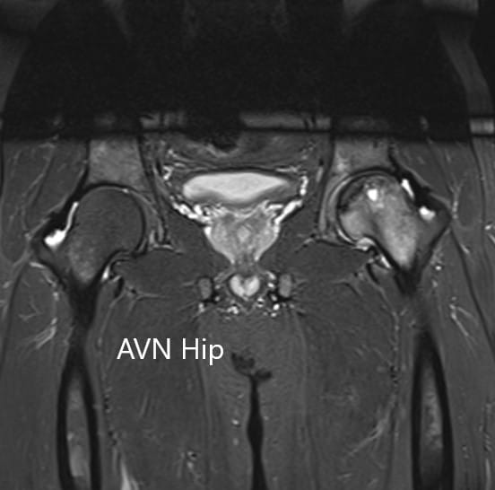 T2WI coronal section of MRI showing AVN hip