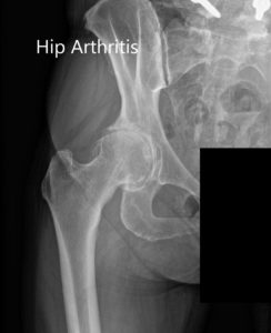 Radiografía preoperatoria que muestra el AP y las vistas laterales de la cadera derecha