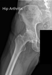 Preoperative X-ray Showing the AP and lateral views of the right hip - img 2