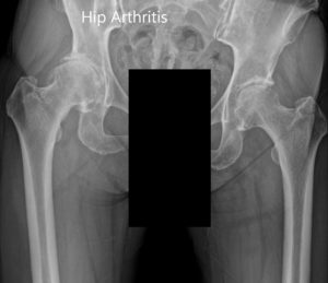 Radiografía preoperatoria que muestra la vista AP de la pelvis con ambas caderas