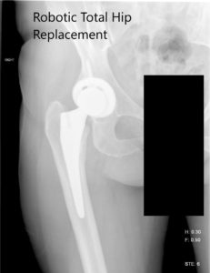 Radiografía postoperatoria de la cadera derecha que muestra PA y vista lateral