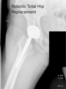 Radiografía postoperatoria de la cadera derecha que muestra AP y vista lateral - img 2