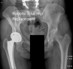 Radiografía postoperatoria de la pelvis que muestra la vista AP