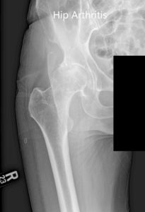 Preoperative AP and lateral views of the right hip joint