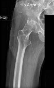 Preoperative AP and lateral views of the right hip joint - img 2