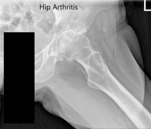 Preoperative X-ray of the left hip showing AP and lateral views - img 2