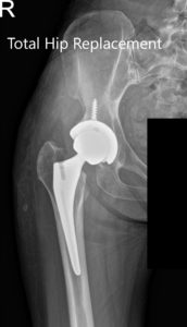 Postoperative X-ray showing the AP and lateral views of the right hip
