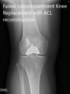 Radiografía preoperatoria que muestra las vistas anteroposterior y lateral de la rodilla derecha