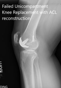 Preoperative x-ray showing the anteroposterior and lateral views of the right knee - img 2