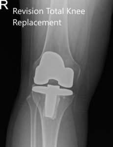 Radiografía postoperatoria que muestra las vistas anteroposterior y lateral de la rodilla derecha