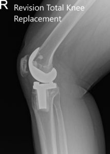 Radiografía postoperatoria que muestra las vistas anteroposterior y lateral de la rodilla derecha - img 2