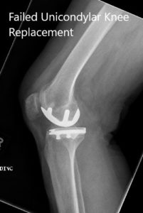 Preoperative X-ray of the right knee in anteroposterior and lateral views
