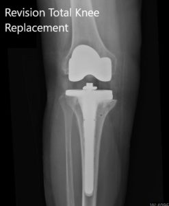 Postoperative X-ray showing the lateral and anteroposterior views of the right knee - img 2