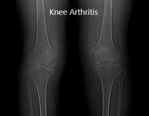 Preoperative X-ray showing AP view of the bilateral knee joints