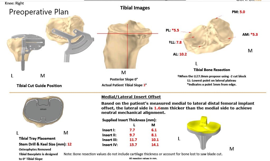 Complete Orthopedics patient specific surgical plan for a Right Custom Knee Replacement in a 59-year-old male