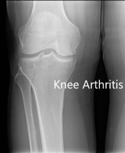 Preoperative X-ray showing AP and lateral view of the right knee joint, and skyline view of both the knee joints