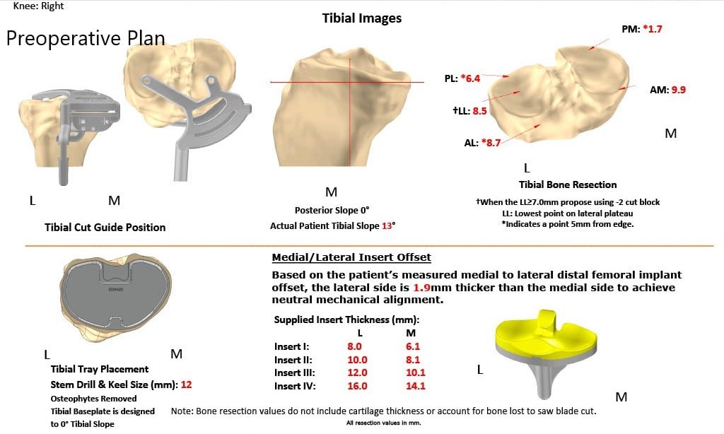 Complete Orthopedics patient specific surgical plan for a Right Custom Total Knee Replacement in a 68-year-old female