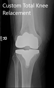 Postoperative X-ray showing AP and lateral images of the right knee