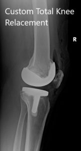 Postoperative X-ray showing AP and lateral images of the right knee - img 2
