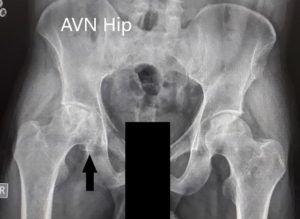 Preoperative X-Ray of the pelvis with both hips in anteroposterior and frog-legged lateral views