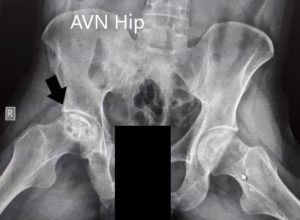 Preoperative X-Ray of the pelvis with both hips in anteroposterior and frog-legged lateral views - img 2