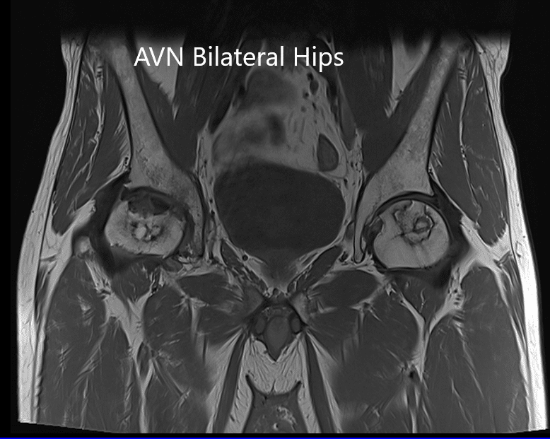 MRI showing bilateral femoral head AVN in T1WI