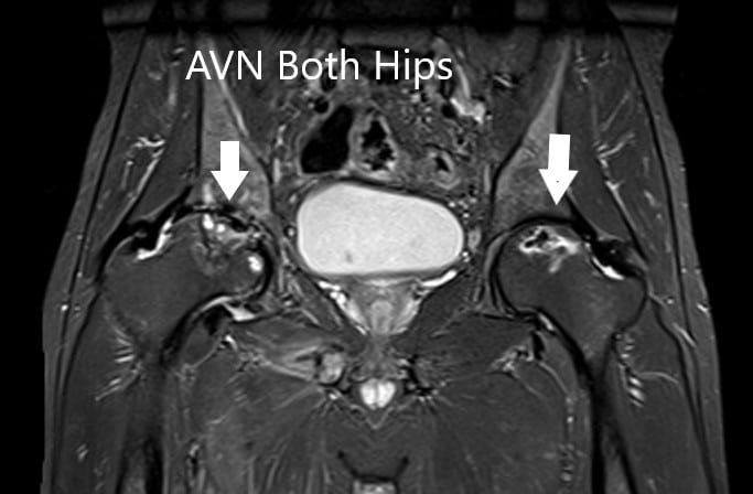 MRI showing bilateral femoral head AVN in T2WI