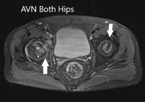 Axial section T1WI showing bilateral AVN of the femoral heads