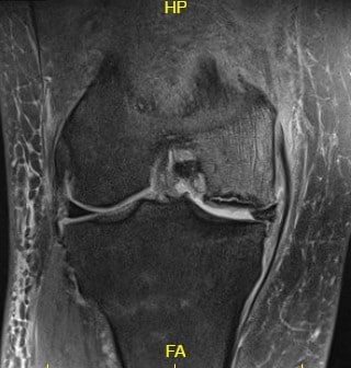 T2 weighted image showing the coronal section of the knee with altered bone marrow signal and rim sign