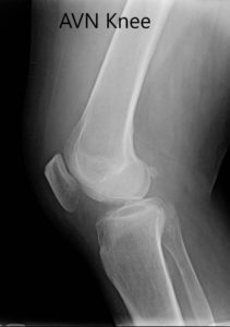 Preoperative X-ray of the right knee in anteroposterior and lateral views - img 2