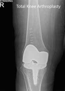 Postoperative x-ray showing the anteroposterior and lateral views of the right knee