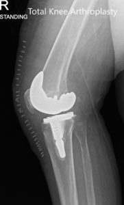 Postoperative x-ray showing the anteroposterior and lateral views of the right knee - img 2
