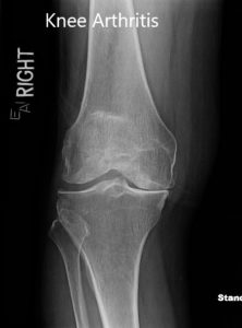 Radiografía preoperatoria que muestra la vista anteroposterior y lateral de la rodilla derecha. Radiografía preoperatoria que muestra la vista anteroposterior y lateral de la rodilla derecha