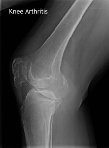 Preoperative X-ray showing the anteroposterior and lateral view of the right knee.Preoperative X-ray showing the anteroposterior and lateral view of the right knee - img 2