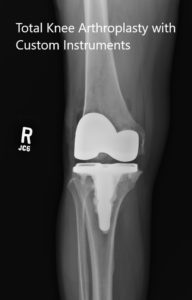 Radiografías postoperatorias que muestran las vistas anteroposterior y lateral de la rodilla derecha