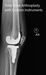 Radiografías postoperatorias que muestran las vistas anteroposterior y lateral de la rodilla derecha - img 2